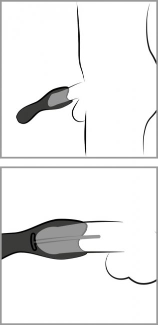 Glans Vibrator with 3 attachable Dilators